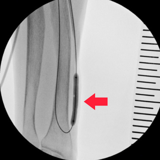 経皮的血管形成術(PTA)前後の血管造影画像